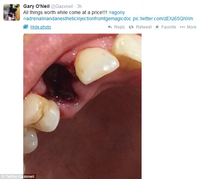 بالصور .. لاعب كوينز بارك يفقد أحد أسنانه أثناء مباراة ويجان 07